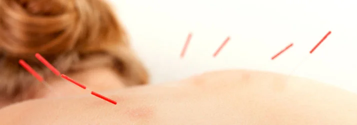 Chiropractic Marinette WI Dry Needling Explained Chiropractic Marinette WI Dry Needling Explained